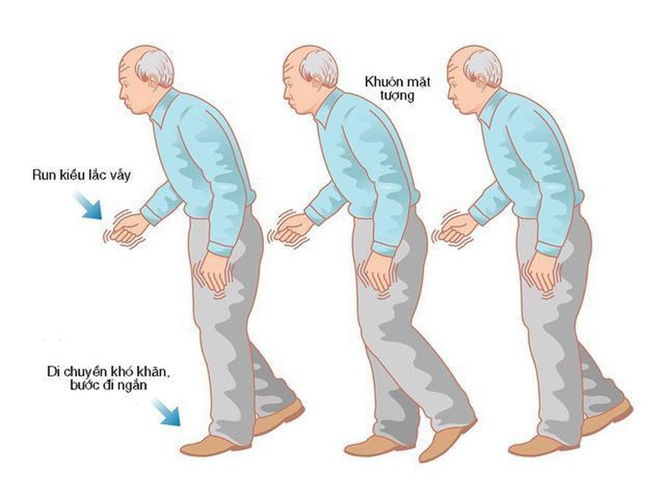 Khởi phát bệnh Parkinson ở người trẻ có gì khác với người cao tuổi? - 3 Khởi phát bệnh Parkinson ở người trẻ có gì khác với người cao tuổi? - 3
