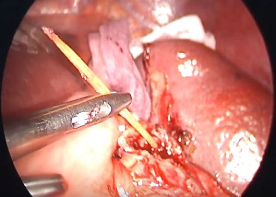 Bị đâm xuyên lách vì ngậm tăm đi ngủ - 2 Bị đâm xuyên lách vì ngậm tăm đi ngủ - 2
