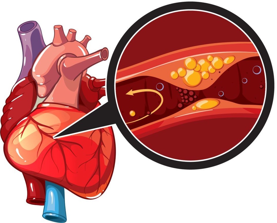 Thiếu máu cơ tim cục bộ nguy hiểm nhưng vẫn có nhiều cách giảm rủi ro - 1 Thiếu máu cơ tim cục bộ nguy hiểm nhưng vẫn có nhiều cách giảm rủi ro - 1