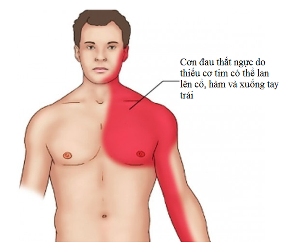 Thiếu máu cơ tim cục bộ nguy hiểm nhưng vẫn có nhiều cách giảm rủi ro - 2 Thiếu máu cơ tim cục bộ nguy hiểm nhưng vẫn có nhiều cách giảm rủi ro - 2