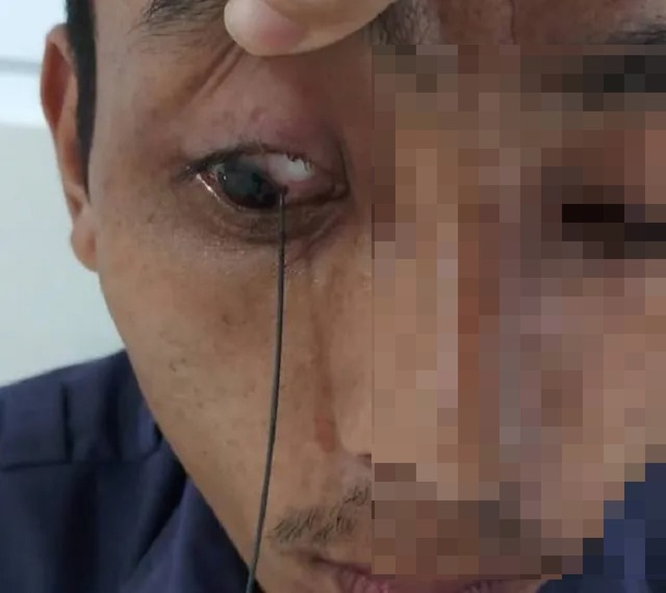 Hi hữu bị que sắt dài xuyên thủng, lơ lửng trong mắt - 1 Hi hữu bị que sắt dài xuyên thủng, lơ lửng trong mắt - 1