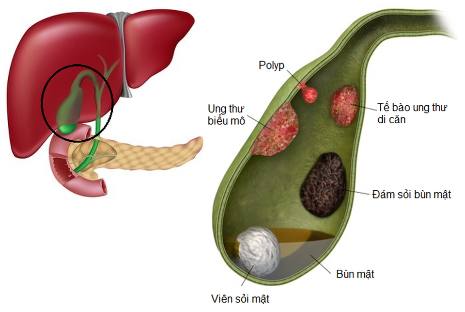 Polyp túi mật: Hiểu để điều trị đúng cách - 1 Polyp túi mật: Hiểu để điều trị đúng cách - 1
