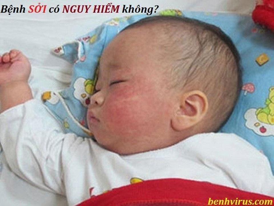 Bệnh sởi có nguy hiểm không? - 2 Bệnh sởi có nguy hiểm không? - 2