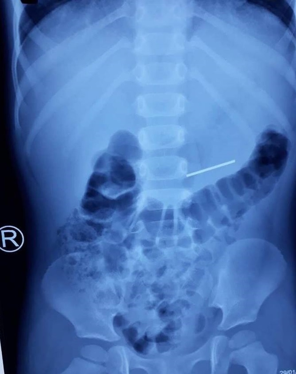 Chưa kịp đón Tết, nhiều trẻ đã gặp tai nạn thương tâm - 3