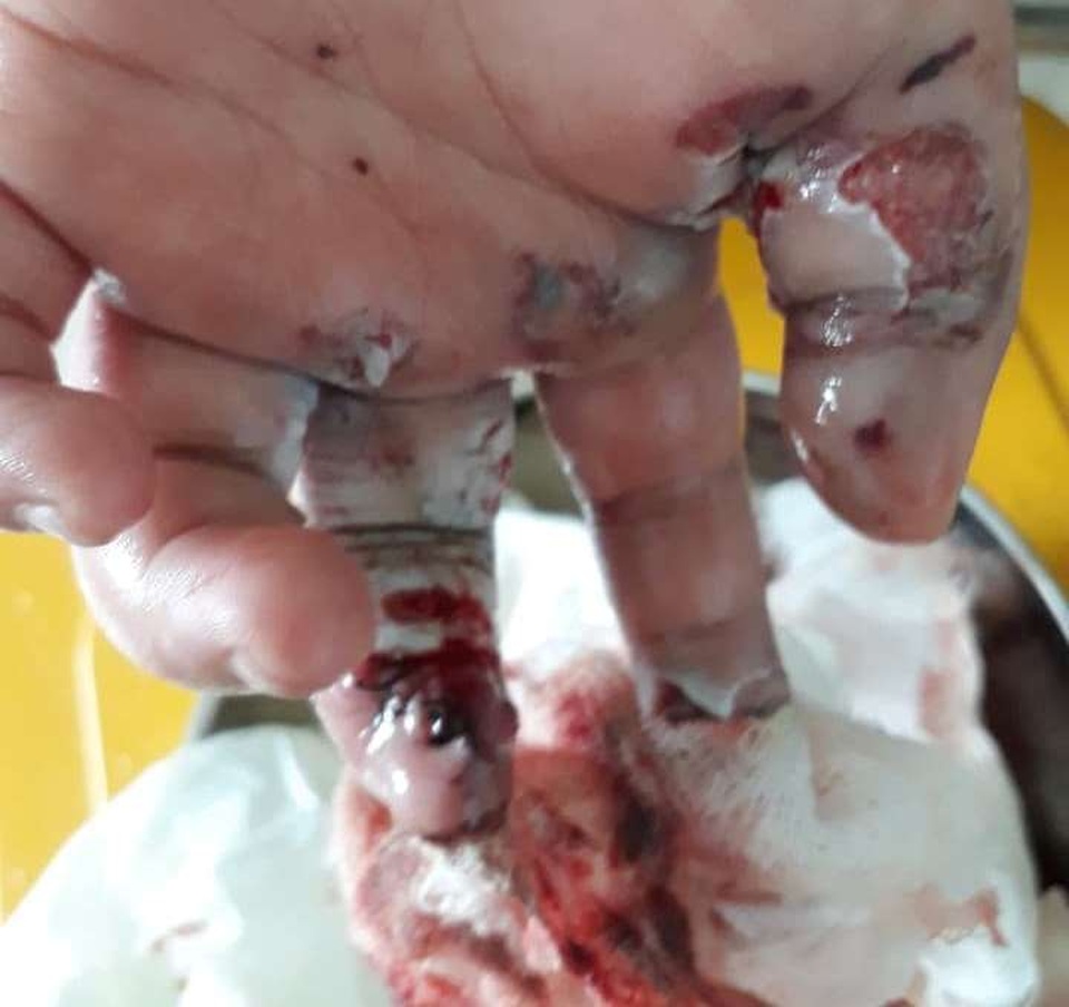 Nhặt pháo đem đốt, 2 bé trai nhập viện vì pháo nổ tét tay - 1 Nhặt pháo đem đốt, 2 bé trai nhập viện vì pháo nổ tét tay - 1