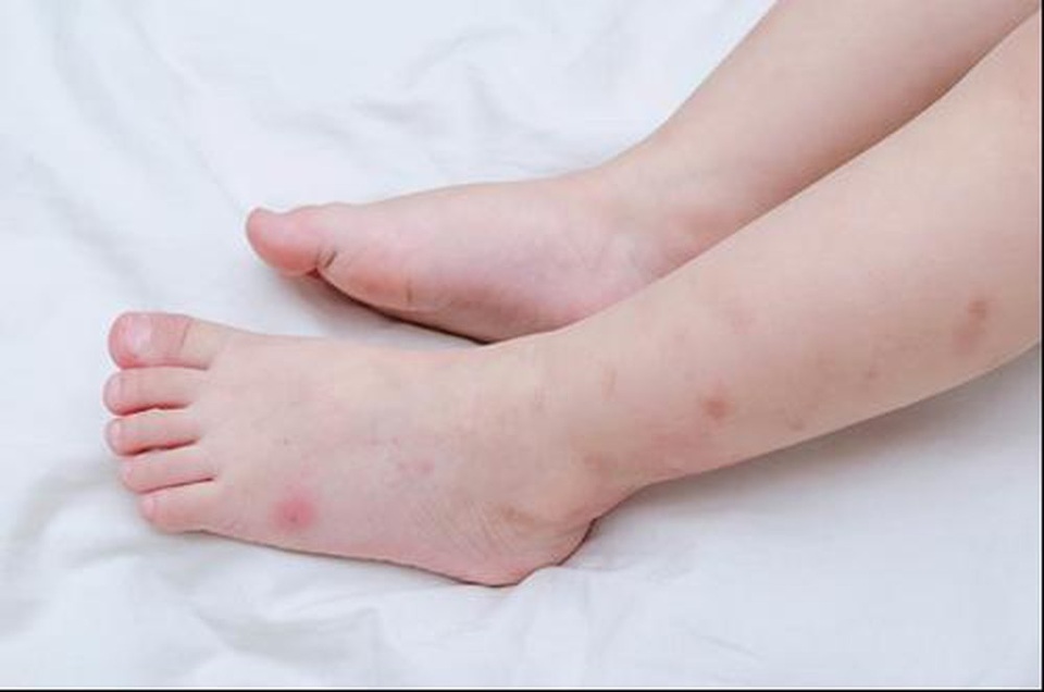 Nổi mề đay ở trẻ em: Hiện tượng phổ biến và phương pháp điều trị đúng chuẩn tại nhà - 1 Nổi mề đay ở trẻ em: Hiện tượng phổ biến và phương pháp điều trị đúng chuẩn tại nhà - 1