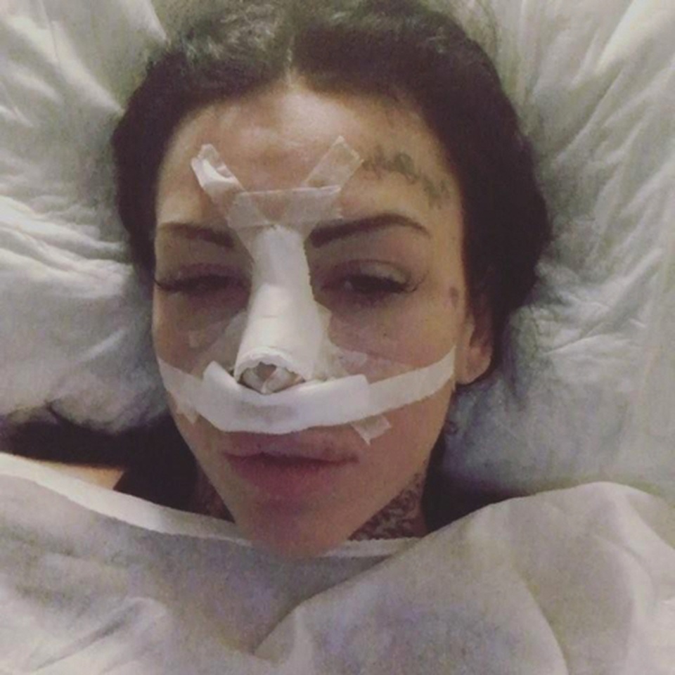 Phẫu thuật gót chân để trông cao hơn - 3 Phẫu thuật gót chân để trông cao hơn - 3