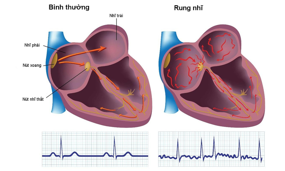 Những cách giúp người bệnh rung nhĩ sống lâu, sống khỏe hơn - 1 Những cách giúp người bệnh rung nhĩ sống lâu, sống khỏe hơn - 1