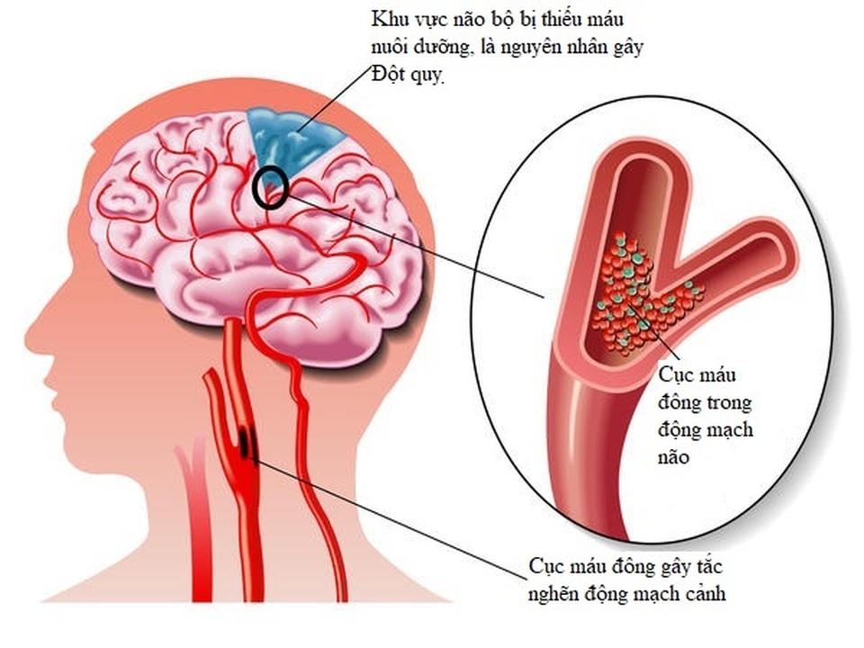 Những cách giúp người bệnh rung nhĩ sống lâu, sống khỏe hơn - 3 Những cách giúp người bệnh rung nhĩ sống lâu, sống khỏe hơn - 3