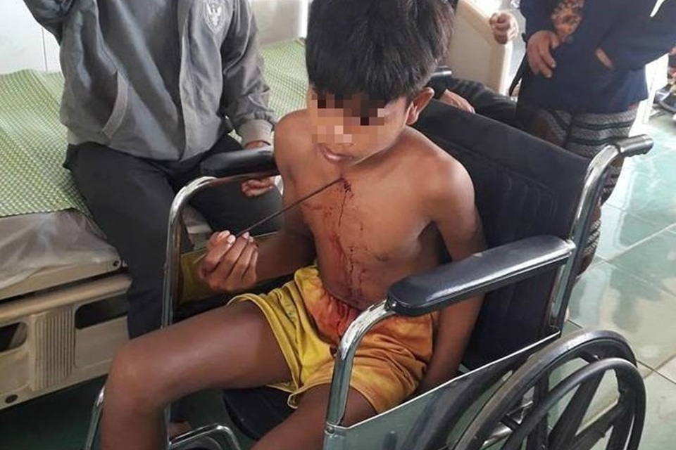 Trượt chân, một thiếu niên bị mũi tên sắt đâm sâu vào ngực - 1 Trượt chân, một thiếu niên bị mũi tên sắt đâm sâu vào ngực - 1