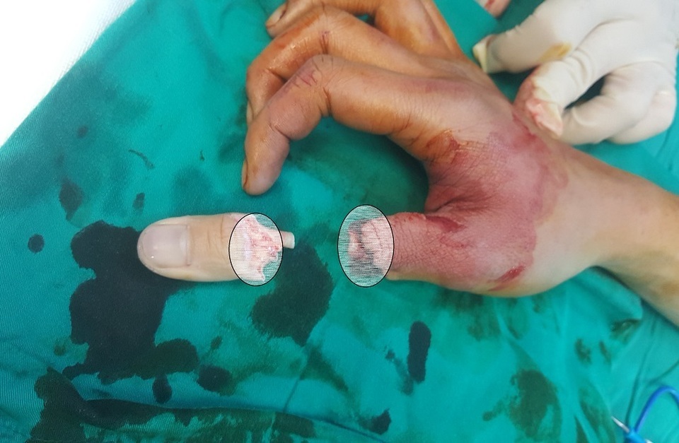 Dây cáp điện thoại rơi xuống cắt lìa ngón tay người đi đường - 1 Dây cáp điện thoại rơi xuống cắt lìa ngón tay người đi đường - 1