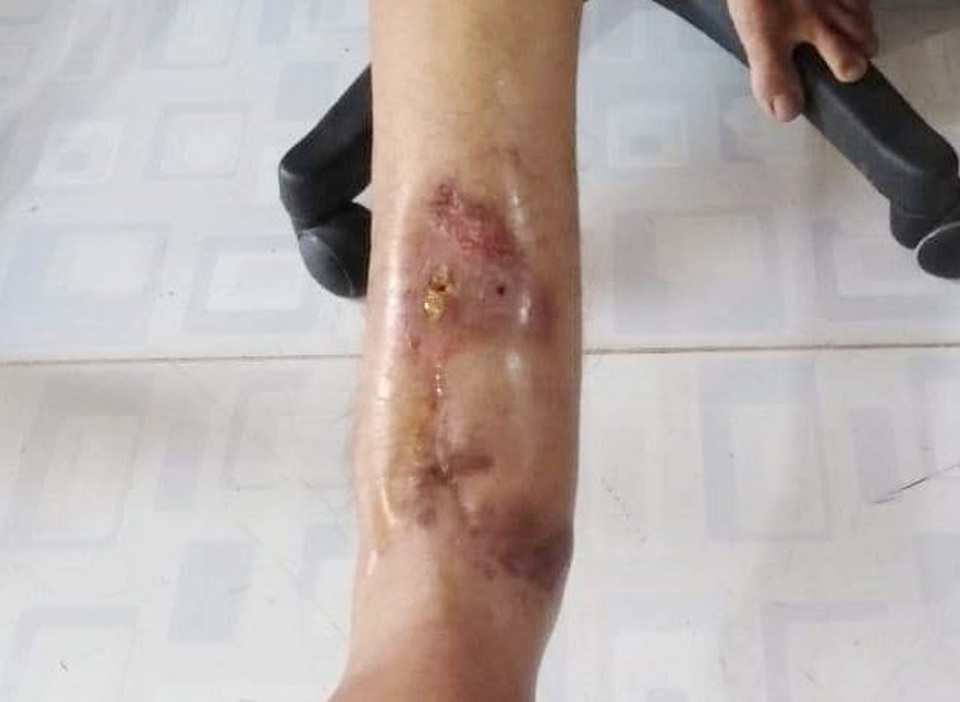 Xương chân phải bị mục chỉ còn mạch máu, nam thanh niên cần phẫu thuật cấp - 3 Xương chân phải bị mục chỉ còn mạch máu, nam thanh niên cần phẫu thuật cấp - 3