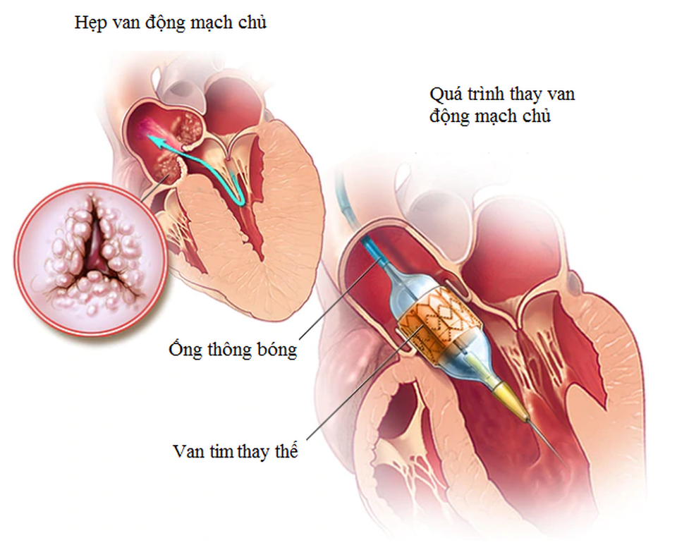 Hẹp van động mạch chủ có nguy hiểm không và người bệnh cần phải làm gì? - 3 Hẹp van động mạch chủ có nguy hiểm không và người bệnh cần phải làm gì? - 3
