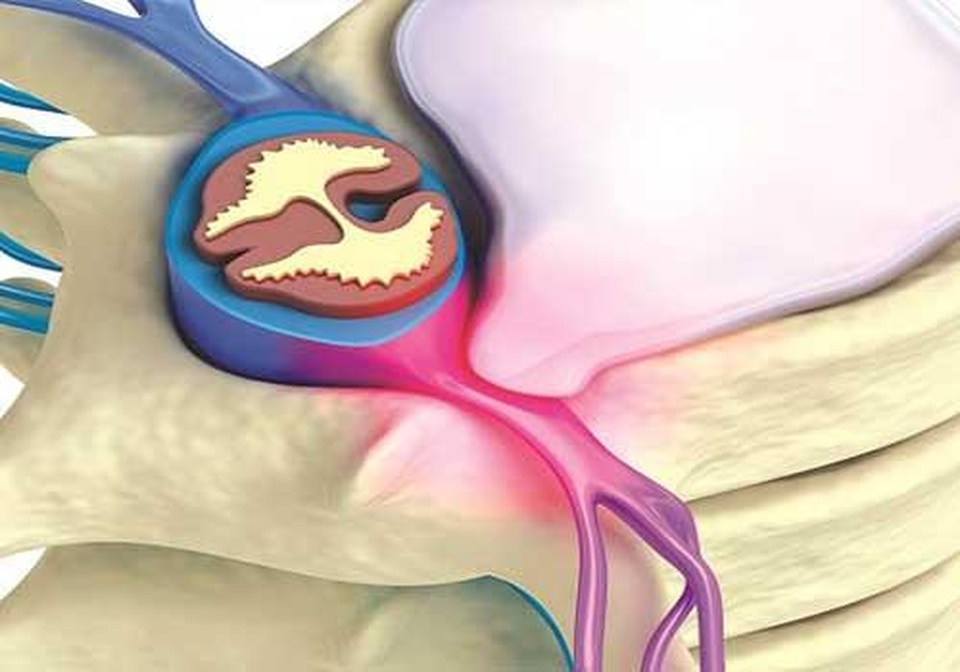 Bị đau lưng lan xuống mông là do đâu? - 2 Bị đau lưng lan xuống mông là do đâu? - 2