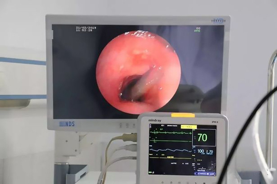 Xem video bác sĩ gắp con đỉa dài 10cm bám chặt trong họng người đàn ông - 1 Xem video bác sĩ gắp con đỉa dài 10cm bám chặt trong họng người đàn ông - 1