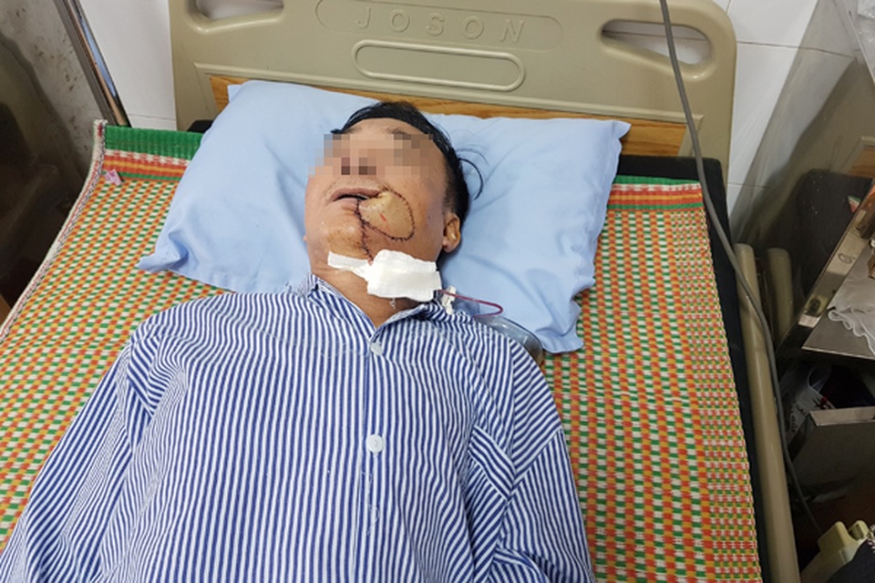Tưởng bị nhiệt miệng, người đàn ông Hà Nội phải cắt 1 góc má vì ung thư - 2