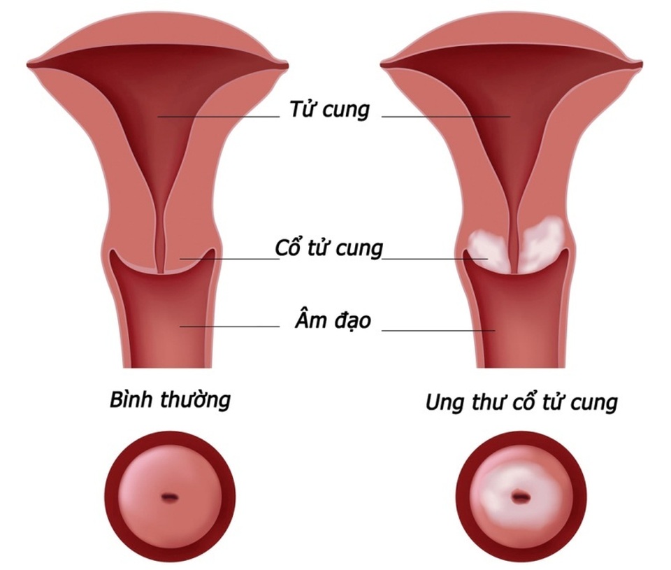 Cổ tử cung sau khi sinh: Tìm hiểu quá trình hồi phục và chăm sóc sức khỏe phụ nữ