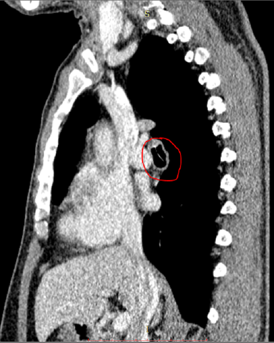 Ho sặc sụa suốt 3 năm vì xương cá lọt vào phế quản - 1