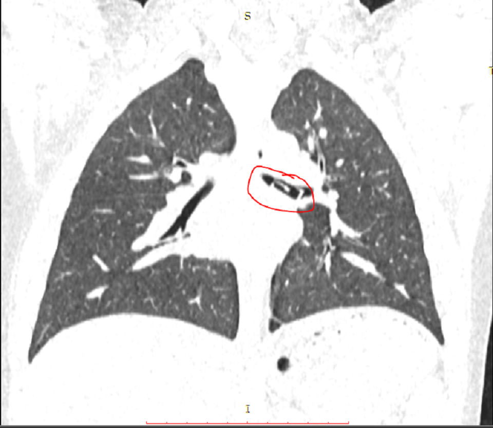 Bé 8 tuổi tím tái vì đồ chơi xếp hình lọt vào phế quản - 1 Bé 8 tuổi tím tái vì đồ chơi xếp hình lọt vào phế quản - 1