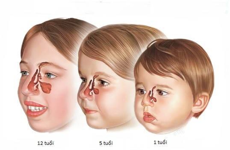 Trẻ nhỏ có thể bị viêm xoang? - 1 Trẻ nhỏ có thể bị viêm xoang? - 1