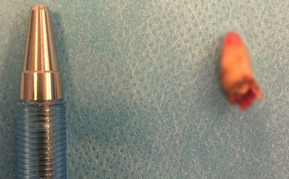 Mất khứu giác 3 năm, người đàn ông bàng hoàng phát hiện răng mọc trong… mũi - 1 Mất khứu giác 3 năm, người đàn ông bàng hoàng phát hiện răng mọc trong… mũi - 1