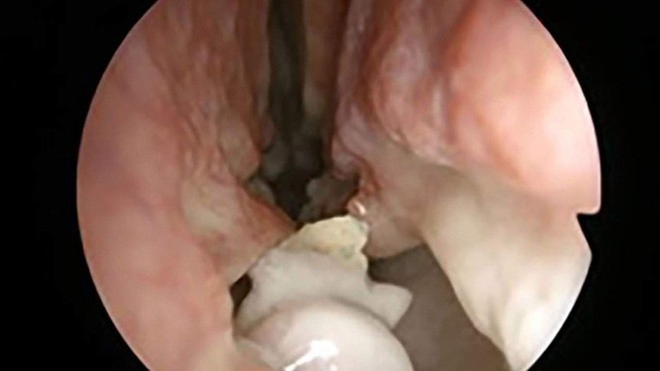 Mất khứu giác 3 năm, người đàn ông bàng hoàng phát hiện răng mọc trong… mũi - 2 Mất khứu giác 3 năm, người đàn ông bàng hoàng phát hiện răng mọc trong… mũi - 2