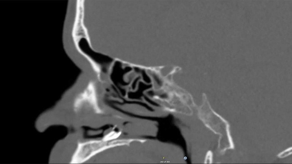 Mất khứu giác 3 năm, người đàn ông bàng hoàng phát hiện răng mọc trong… mũi - 3 Mất khứu giác 3 năm, người đàn ông bàng hoàng phát hiện răng mọc trong… mũi - 3