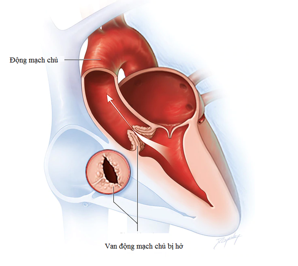 Hở van động mạch chủ và các câu hỏi thường gặp - 1 Hở van động mạch chủ và các câu hỏi thường gặp - 1