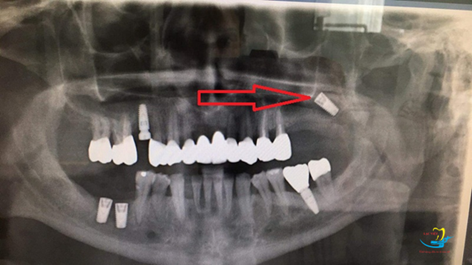 4 lưu ý khi lựa chọn trung tâm trồng răng implant - 1 4 lưu ý khi lựa chọn trung tâm trồng răng implant - 1