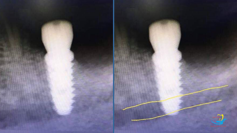 4 lưu ý khi lựa chọn trung tâm trồng răng implant - 2 4 lưu ý khi lựa chọn trung tâm trồng răng implant - 2