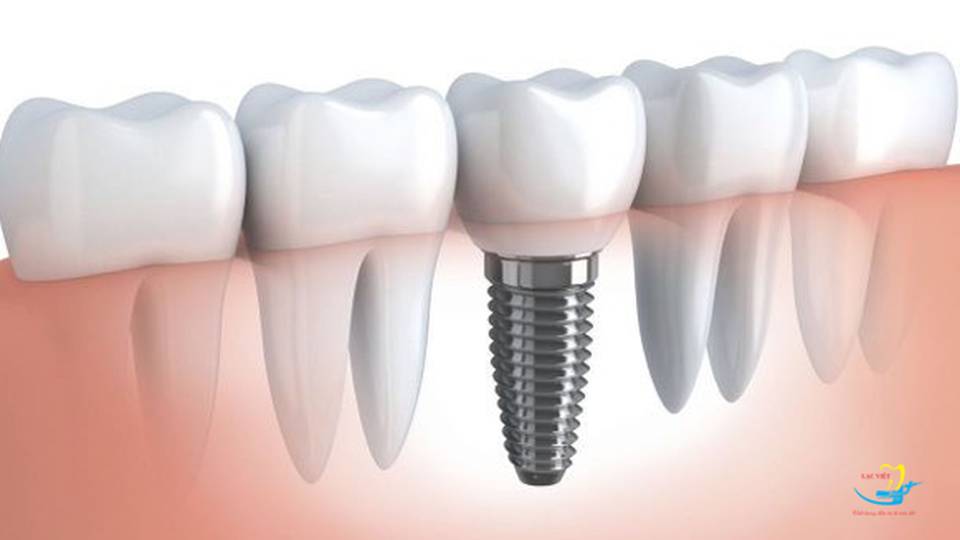 4 lưu ý khi lựa chọn trung tâm trồng răng implant - 5 4 lưu ý khi lựa chọn trung tâm trồng răng implant - 5