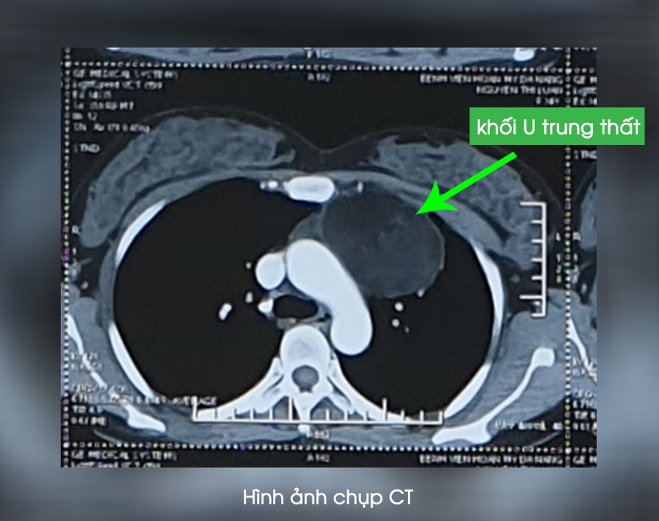 Đau sau lưng, phát hiện khối u trung thất lớn - 1 Đau sau lưng, phát hiện khối u trung thất lớn - 1
