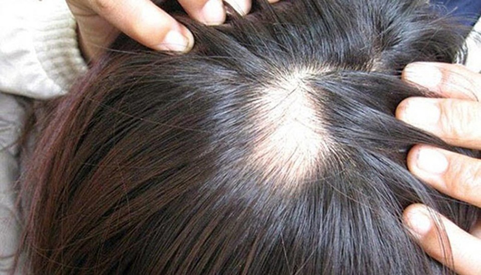 Xóa bỏ nỗi lo rụng tóc, hói đầu với các loại tinh dầu quen thuộc - 1 Xóa bỏ nỗi lo rụng tóc, hói đầu với các loại tinh dầu quen thuộc - 1