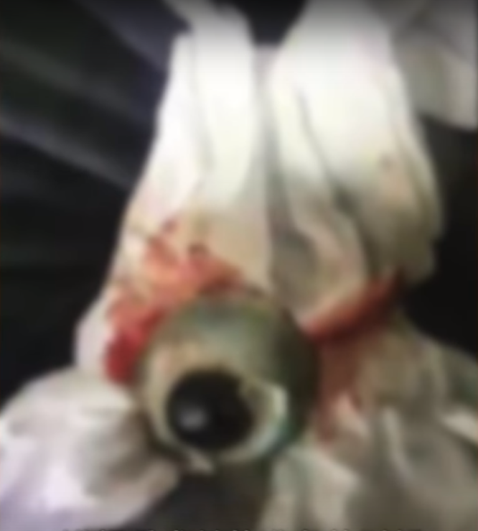 Say rượu vấp ngã, nam thanh niên rơi cả nhãn cầu ra ngoài - 1 Say rượu vấp ngã, nam thanh niên rơi cả nhãn cầu ra ngoài - 1