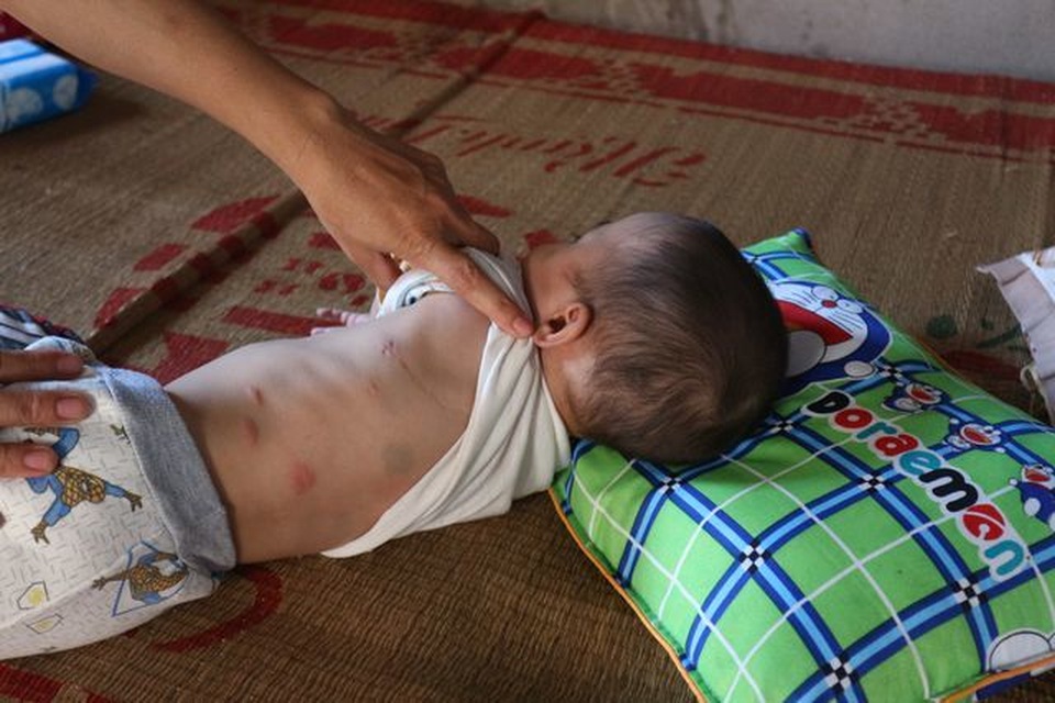 Hơn 157 triệu đồng đến với cháu bé 15 tháng tuổi bị tim bẩm sinh phức tạp - 3 Hơn 157 triệu đồng đến với cháu bé 15 tháng tuổi bị tim bẩm sinh phức tạp - 3