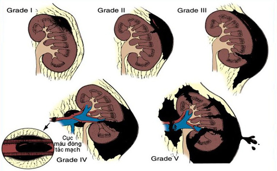 Trẻ té ngã, coi chừng chấn thương thận - 1..jpg