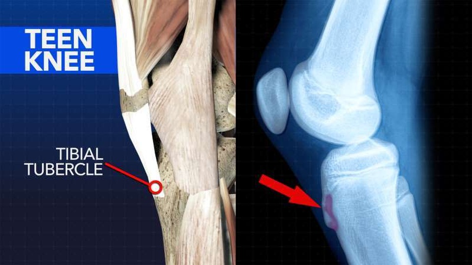 3 vấn đề hay gặp ở khớp gối và cách khắc phục - 1