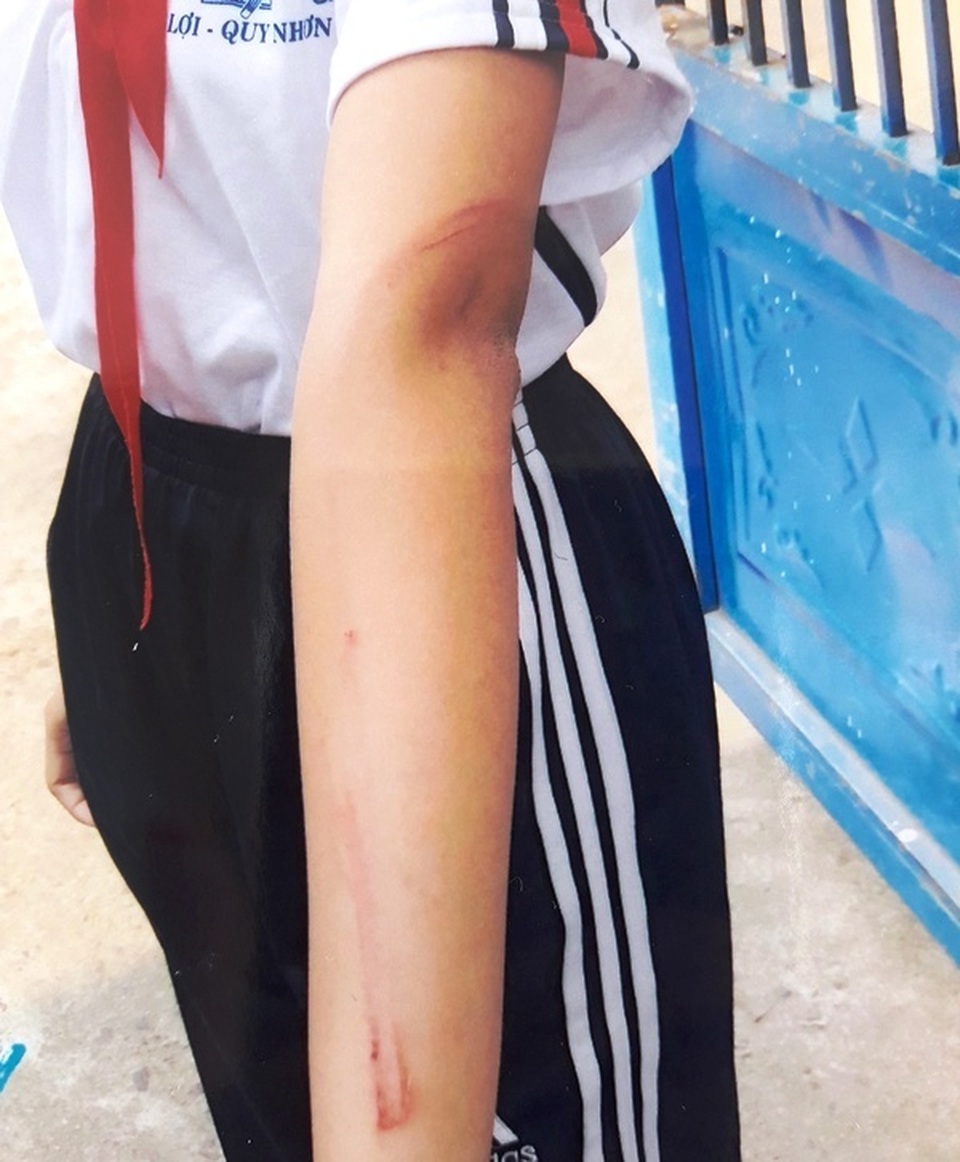 Bé gái mồ côi mẹ bị cha đánh đập nặng nề - 1 Bé gái mồ côi mẹ bị cha đánh đập nặng nề - 1