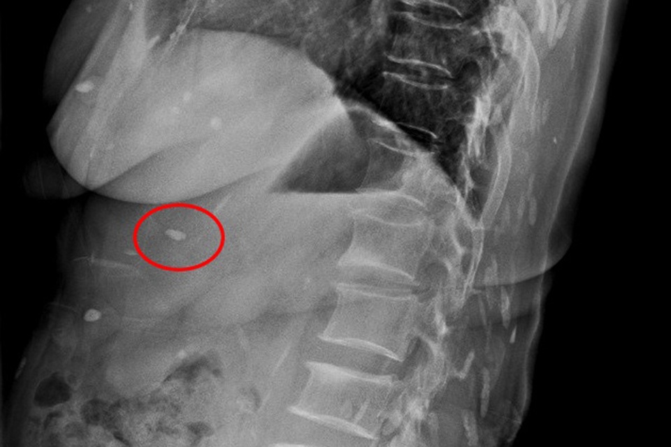 Người phụ nữ bị sán lá gan ký sinh khắp cơ thể - 2