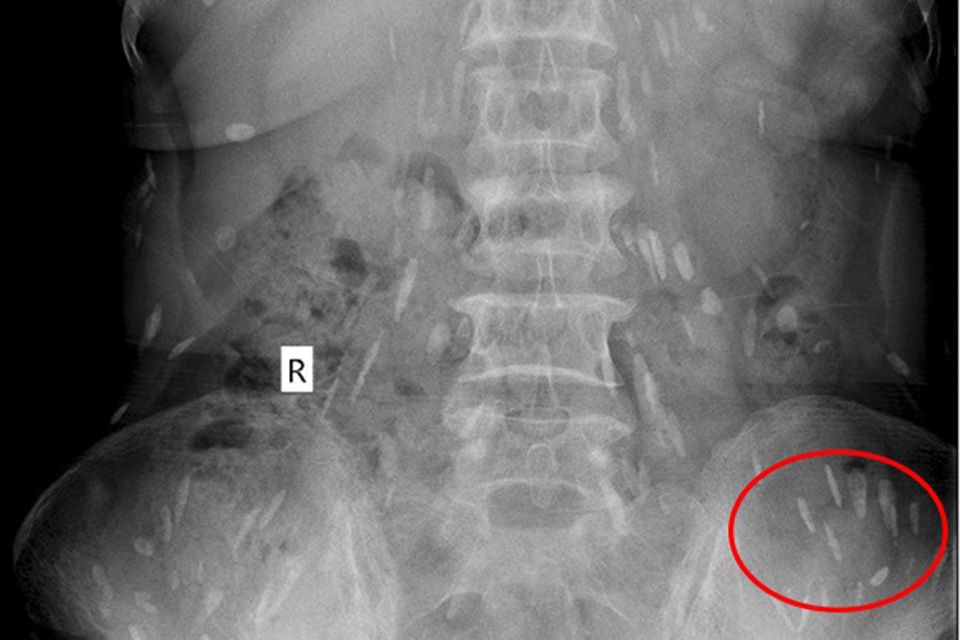 Người phụ nữ bị sán lá gan ký sinh khắp cơ thể - 3