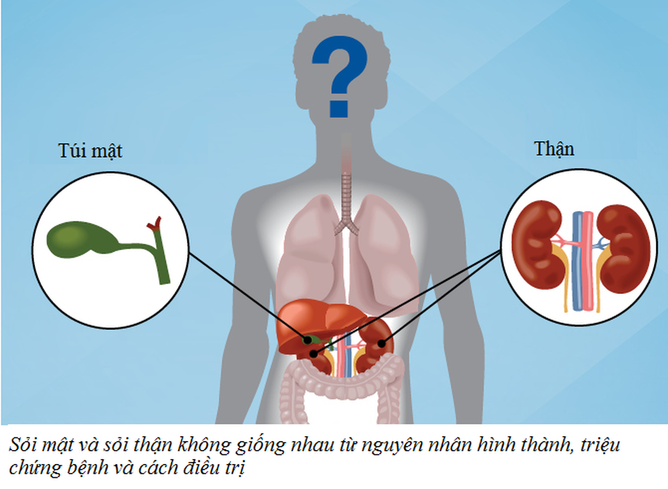 Lật lại những lầm tưởng về bệnh sỏi mật, giúp bài sỏi dễ dàng hơn Lật lại những lầm tưởng về bệnh sỏi mật, giúp bài sỏi dễ dàng hơn