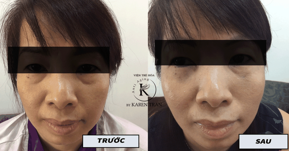 An toàn và hiệu quả hơn trong trẻ hoá bằng sợi hữu cơ - 2 An toàn và hiệu quả hơn trong trẻ hoá bằng sợi hữu cơ - 2