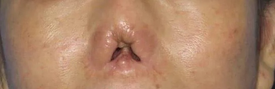 Kỳ lạ cắt vành tai tạo hình mũi cho nữ bệnh nhân - 1 Kỳ lạ cắt vành tai tạo hình mũi cho nữ bệnh nhân - 1