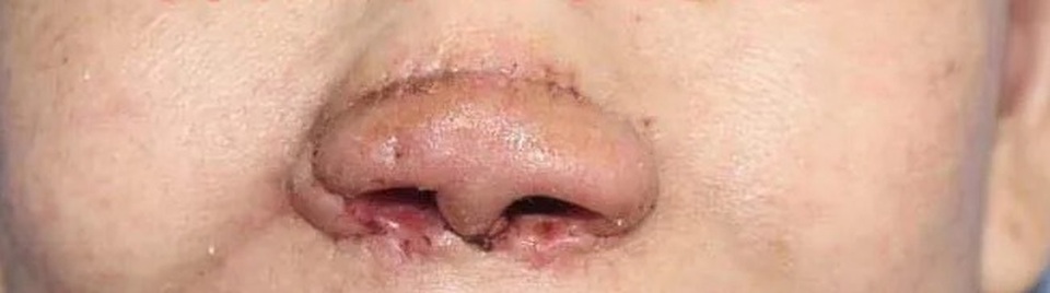 Kỳ lạ cắt vành tai tạo hình mũi cho nữ bệnh nhân - 2 Kỳ lạ cắt vành tai tạo hình mũi cho nữ bệnh nhân - 2