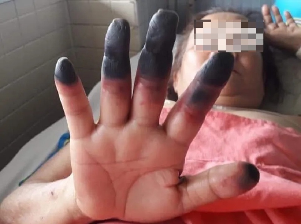 Các ngón chân, tay khô đen như phim “kinh dị” - 1 Các ngón chân, tay khô đen như phim “kinh dị” - 1