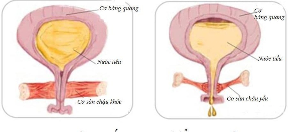 Tiểu són, tiểu nhiều lần, tiểu gấp, hội chứng bàng quang kích thích: Phải làm sao? - 1 Tiểu són, tiểu nhiều lần, tiểu gấp, hội chứng bàng quang kích thích: Phải làm sao? - 1