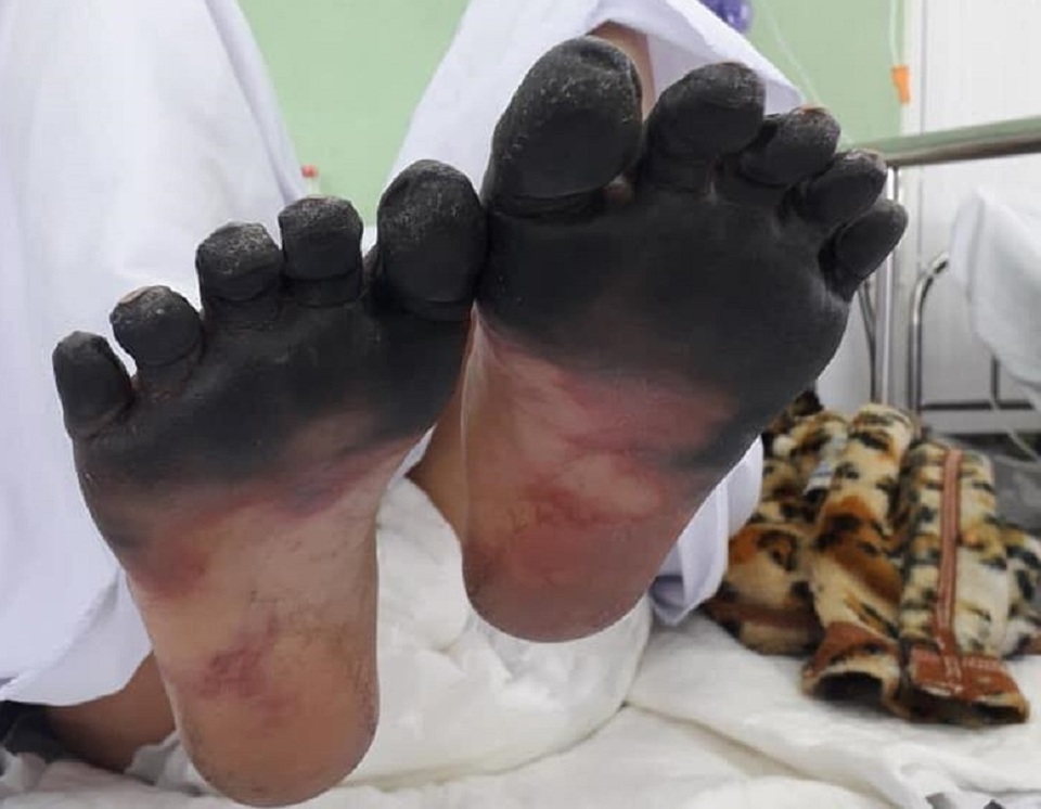 Các ngón chân, tay khô đen như phim “kinh dị” - 3 Các ngón chân, tay khô đen như phim “kinh dị” - 3