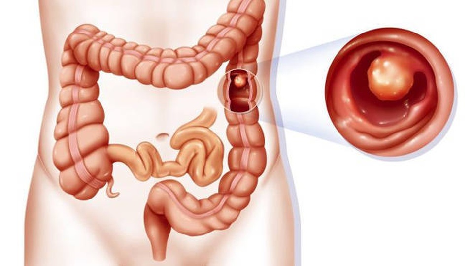Triệu chứng bệnh đại tràng nhận biết sớm xử lý để phòng ung thư - 2 Triệu chứng bệnh đại tràng nhận biết sớm xử lý để phòng ung thư - 2