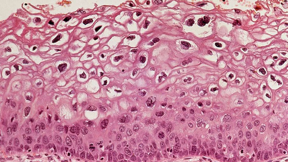 Vắc-xin HPV giúp giảm đáng kể nguy cơ ung thư cổ tử cung - 1 Vắc-xin HPV giúp giảm đáng kể nguy cơ ung thư cổ tử cung - 1