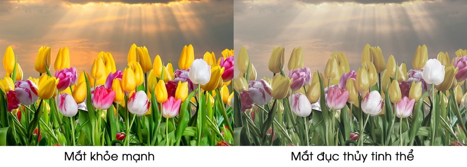 Mắt sáng khỏe sau vài tháng - Hy vọng mới cho bệnh đục thủy tinh thể ở người già - 1 Mắt sáng khỏe sau vài tháng - Hy vọng mới cho bệnh đục thủy tinh thể ở người già - 1